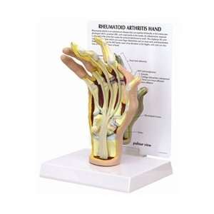  Rheumatoid Arthritis (RA) Hand Model Health & Personal 