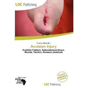  Avulsion Injury (9786200582850) Timoteus Elmo Books
