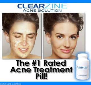 BEST ACNE TREATMENT PILL Rid Pimples Clear Skin Vitamin  
